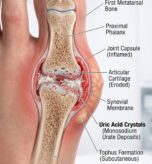 Foot_joint_with_uric_acid_202607111730